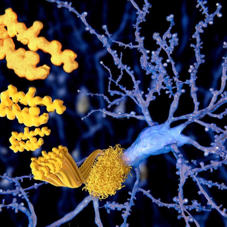Alzheimer. Difetti della mielina promuovono la malattia in età avanzata